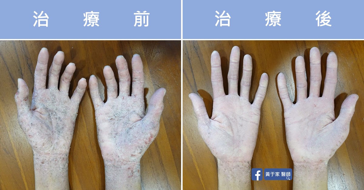 手部濕疹患者治療前後皮膚外觀比對
