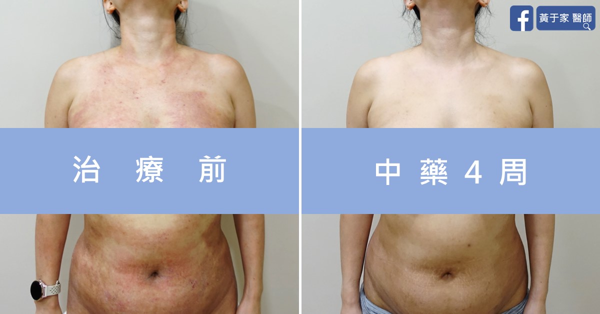 慢性蕁麻疹患者治療前後皮膚外觀比對