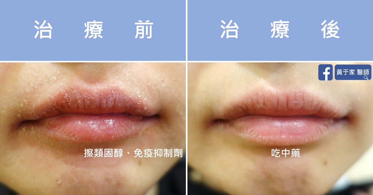同一位患者嘴唇的比對，左標示「治療前」與「擦類固醇、免疫抑制劑」，唇面乾裂脫屑；右標示「治療後」與「吃中藥」