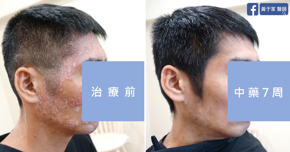 乾癬患者治療前後皮膚外觀比對