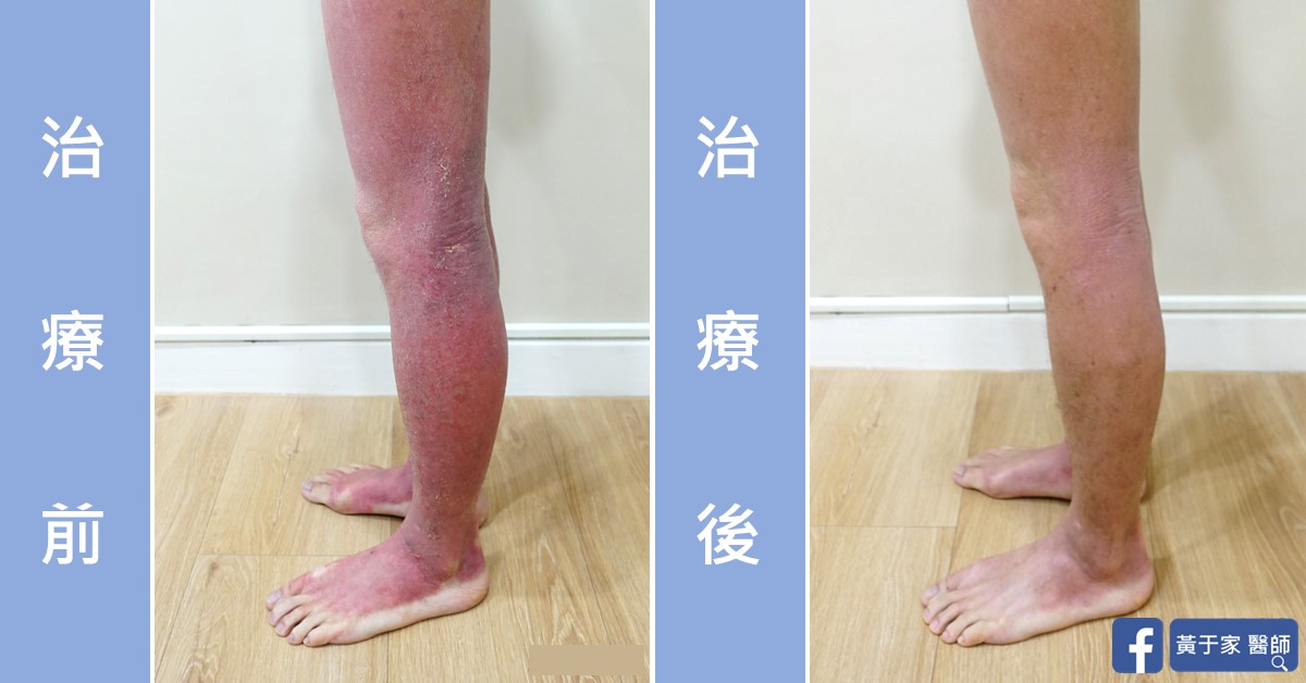 Atopic dermatitis, skin before and after treatment (1)