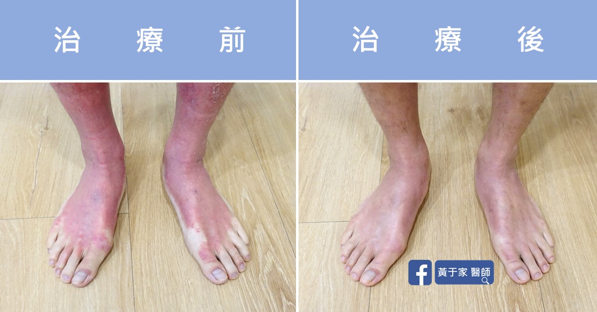 Atopic dermatitis, skin before and after treatment (2)