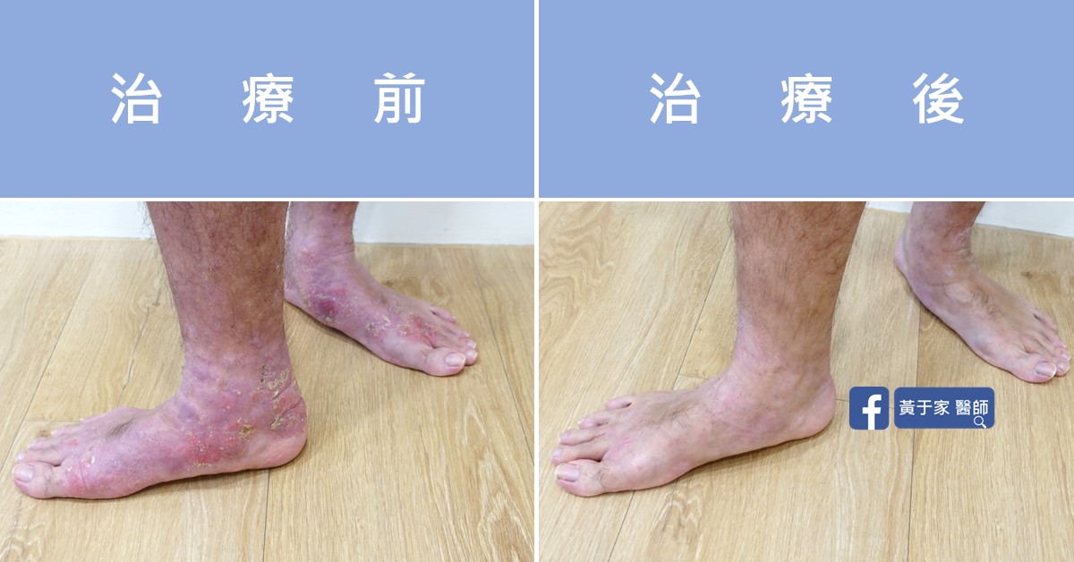 Chronic eczema, skin before and after treatment