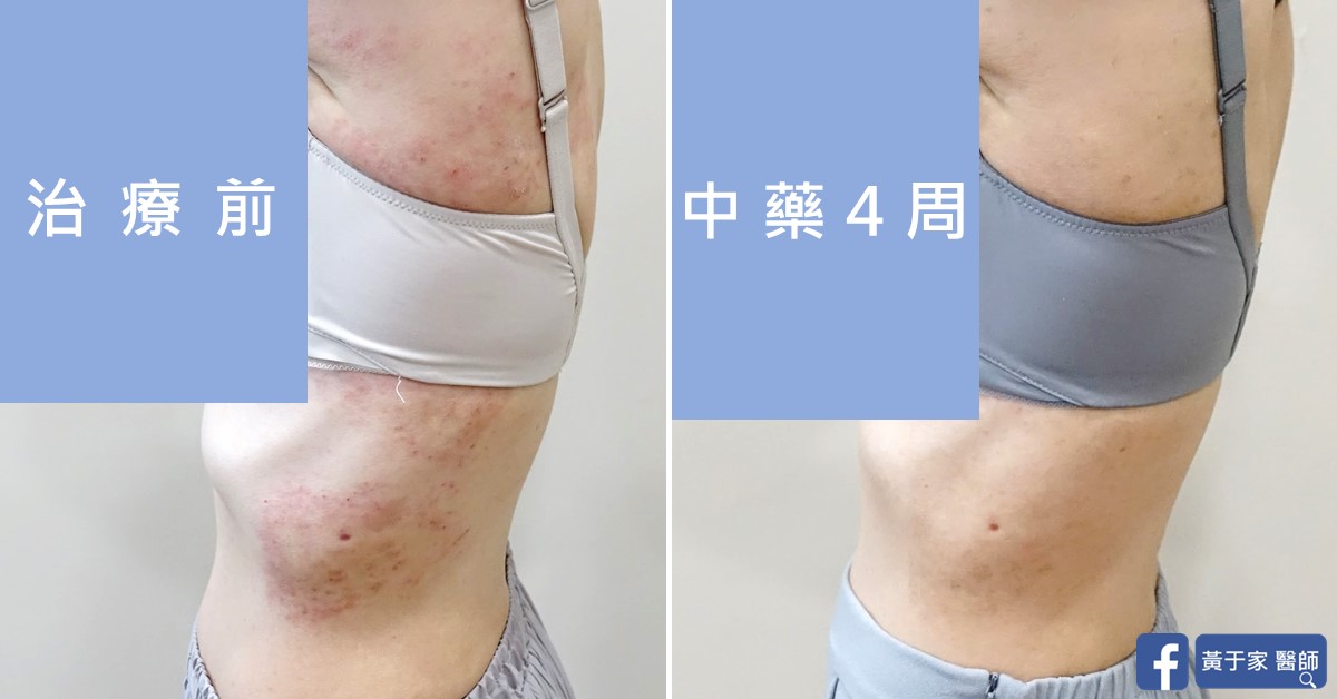 Chronic eczema, skin before and after treatment