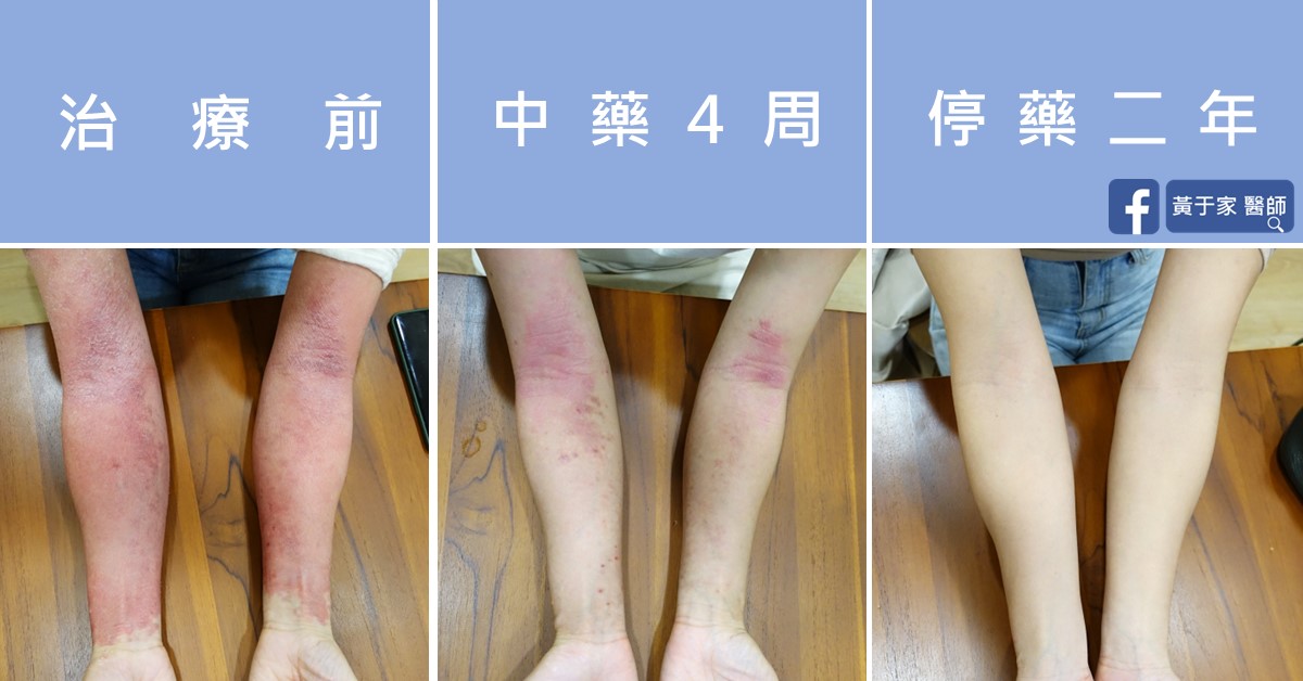 同一位異位性皮膚炎患者雙側前臂的三張並排照片，依序標示「治療前」「中藥 4 周」「停藥二年」