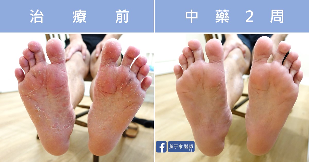 Dyshidrotic eczema before and after comparison