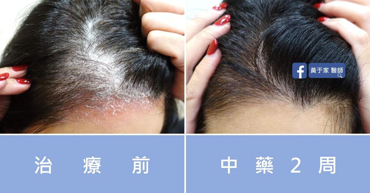 Psoriasis before and after comparison (1)