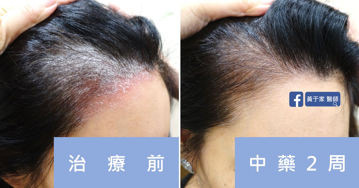 Psoriasis before and after comparison (2)