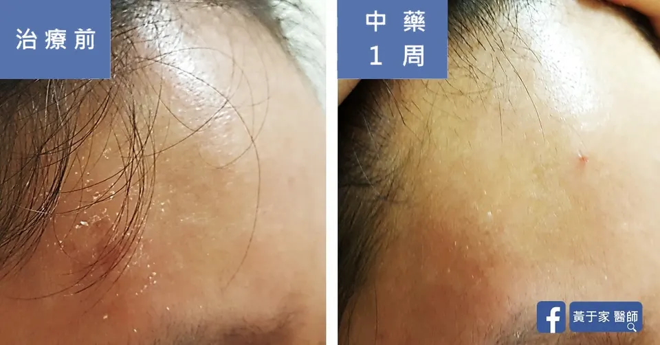 異位性皮膚炎青少女額頭脫屑，治療前與中藥 1 週對照