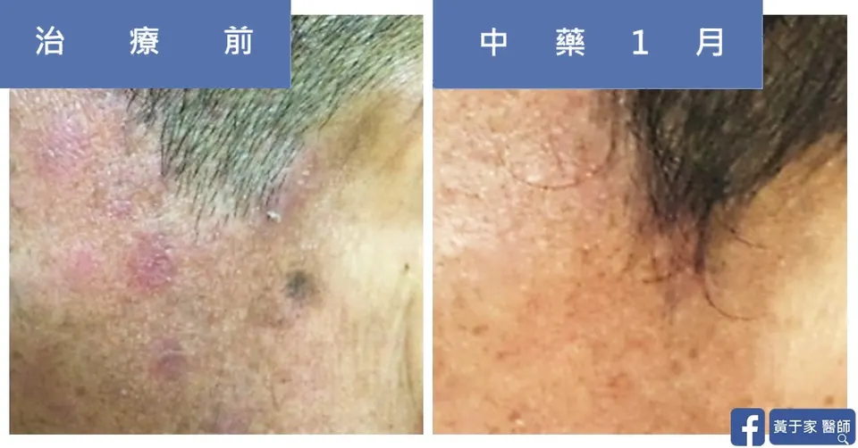 骨髓移植後患者額角紅疹，治療前與中藥 1 個月對照