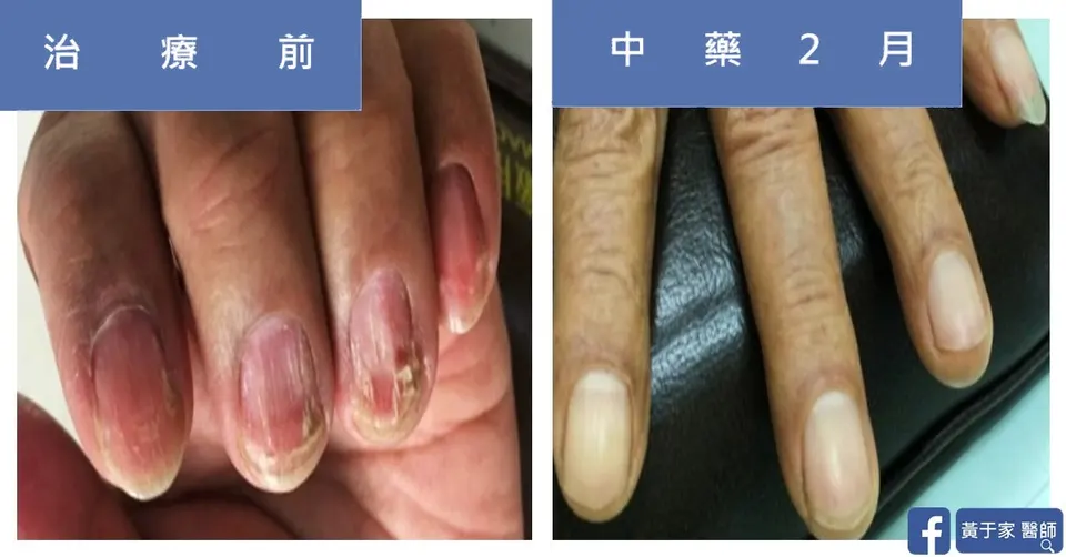 骨髓移植後患者指甲破損，治療前與中藥 2 個月對照