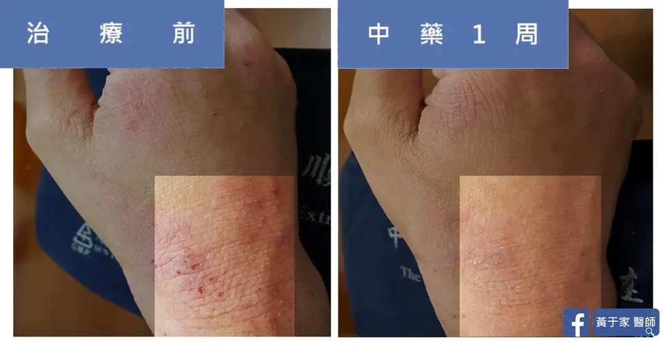 異位性皮膚炎手背與手腕抓傷，治療前與中藥 1 週對照