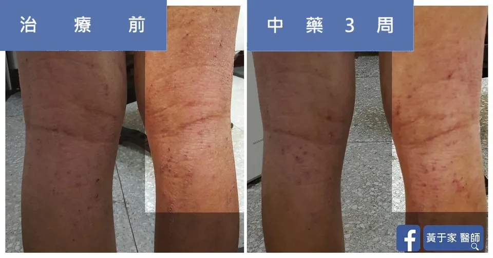 異位性皮膚炎膝窩皮膚，治療前與中藥 3 週對照