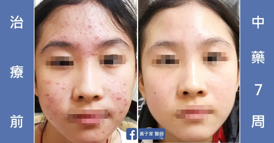 青少女臉部青春痘與脂漏，治療前與中藥 7 週對照
