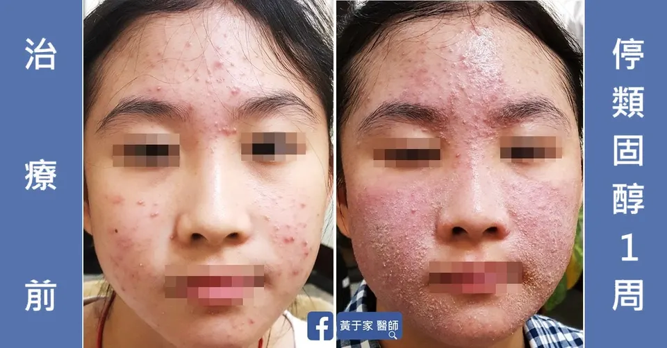 停用類固醇藥膏 1 週後臉部紅腫脫屑的反彈，與治療前對照