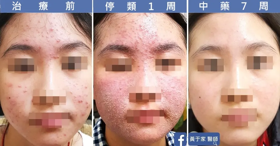 臉部治療前、停類固醇 1 週與中藥 7 週三階段對照