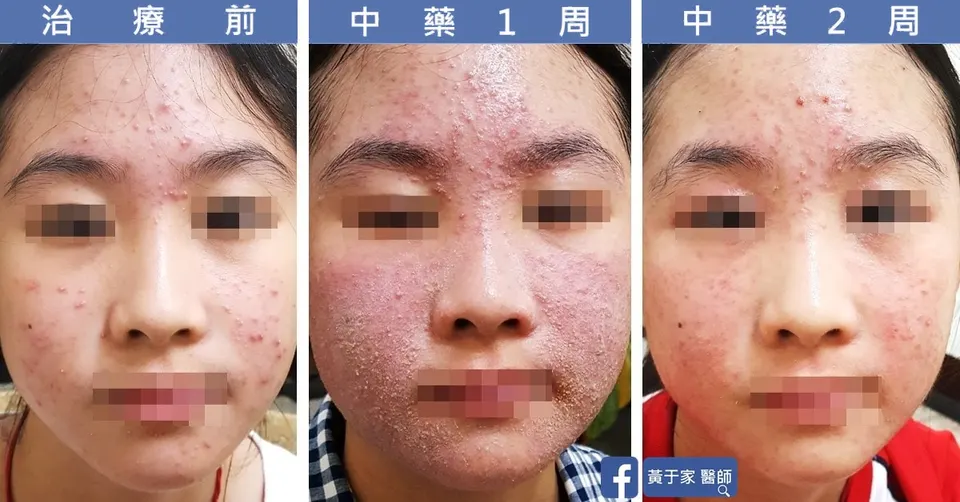 臉部青春痘治療前、中藥 1 週與中藥 2 週對照