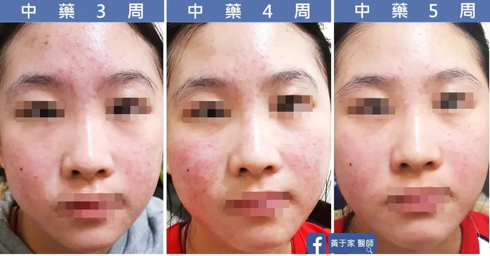 臉部青春痘中藥第 3、4、5 週的變化