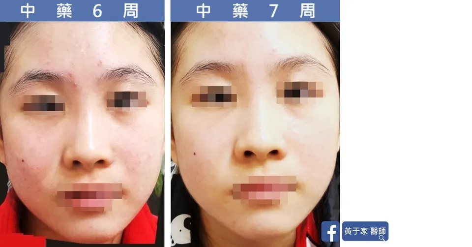 臉部青春痘中藥第 6 週與第 7 週對照