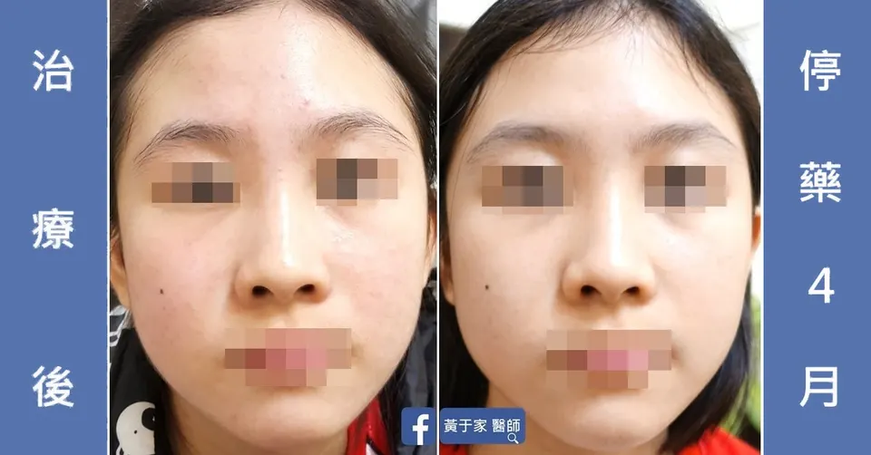 臉部治療結束時與停藥 4 個月後對照