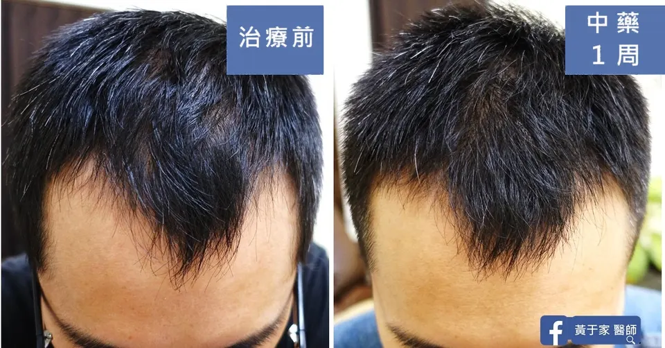 同一位患者前額髮線的比對，左標示「治療前」，右標示「中藥 1 周」