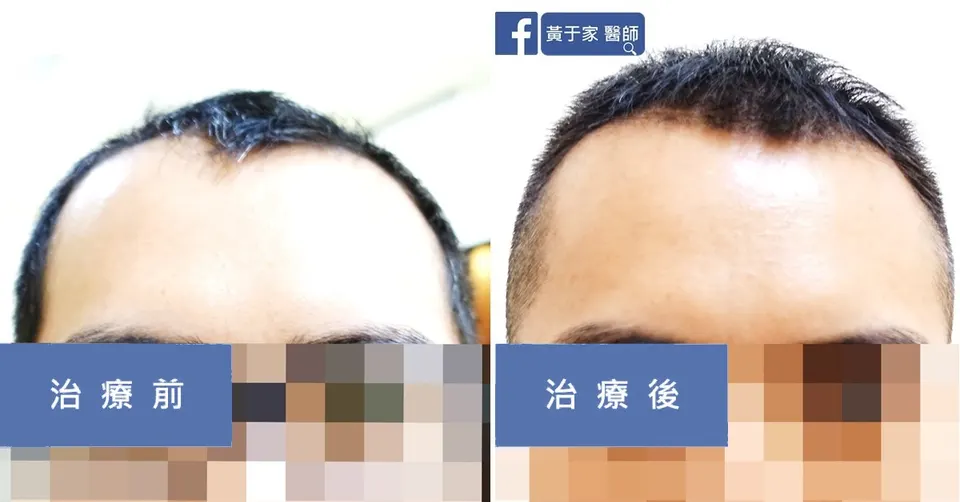 同一位患者正面臉部的比對（眼部以下打馬賽克），左標示「治療前」，右標示「治療後」