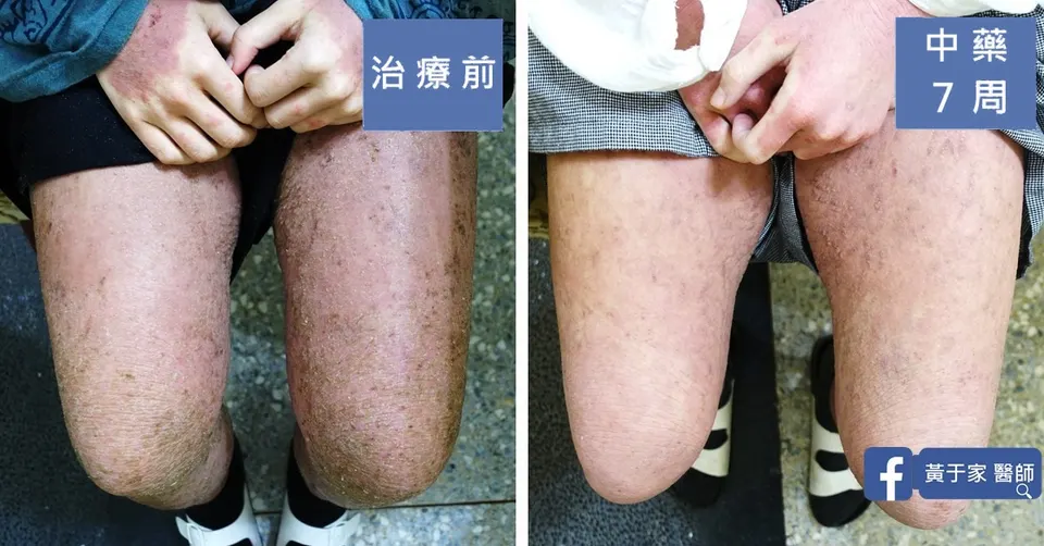 疑似類固醇戒斷的大腿與膝蓋脫屑，治療前與中藥 7 週對照