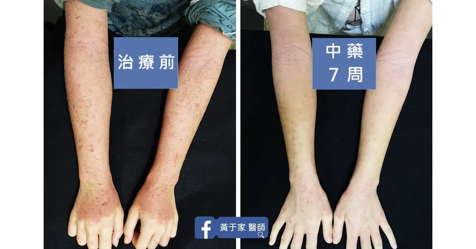 雙前臂與手背脫屑紅疹，治療前與中藥 7 週對照