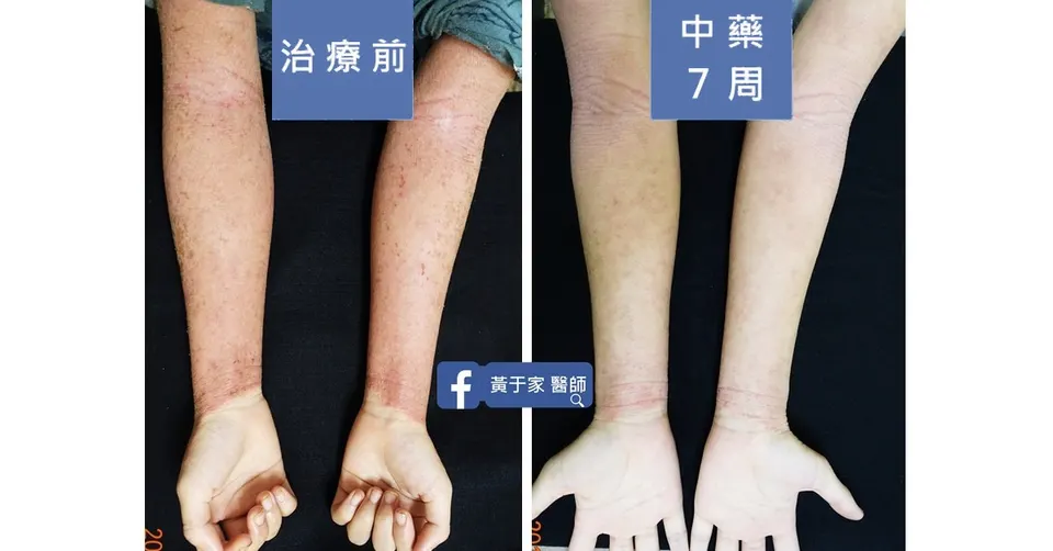 雙前臂內側與手腕紅疹，治療前與中藥 7 週對照