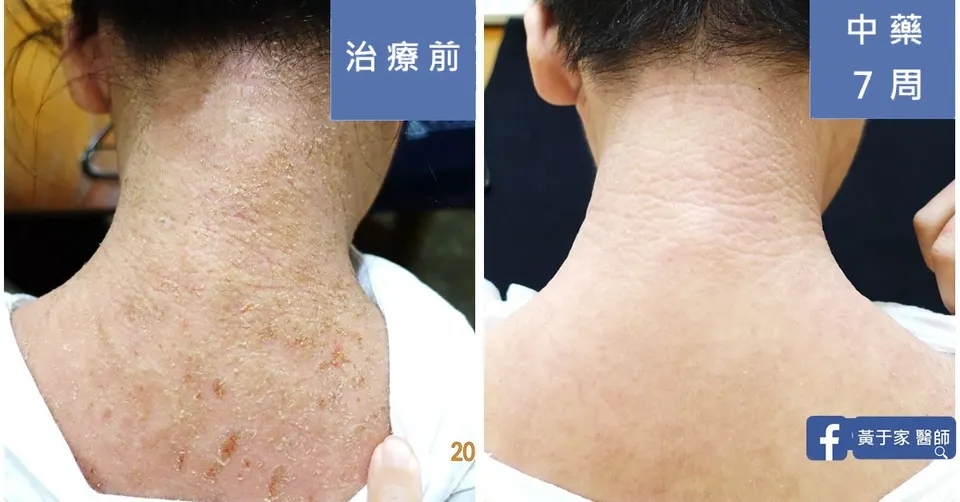 後頸大片脫屑結痂，治療前與中藥 7 週對照