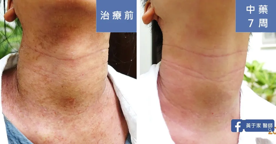 頸部前側色素沉著與脫屑，治療前與中藥 7 週對照