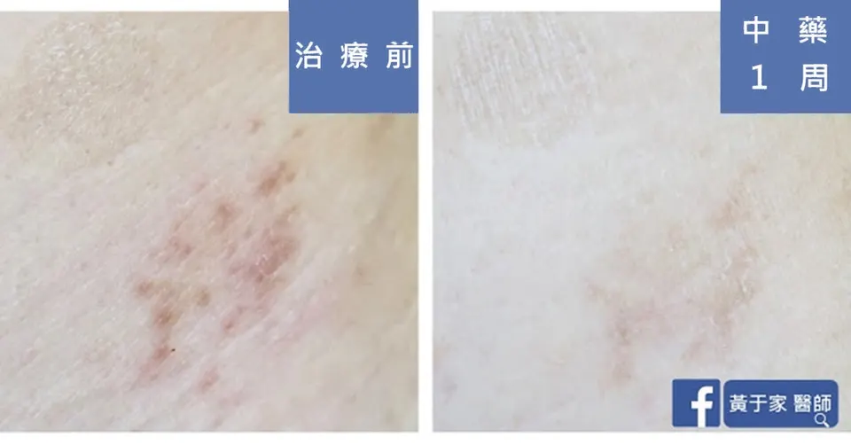 第一位患者局部紅疹的比對，左標示「治療前」，右標示「中藥 1 周」