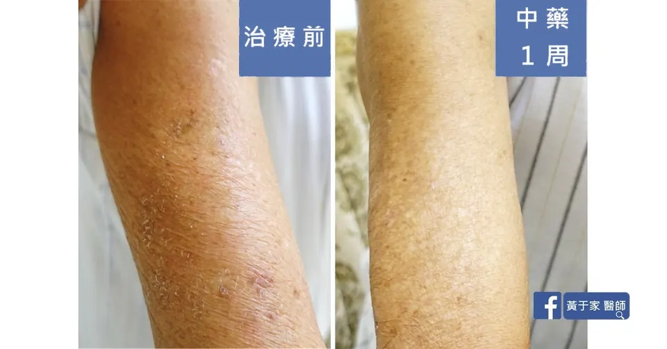 年長患者手臂皮膚的比對，左標示「治療前」，右標示「中藥 1 周」