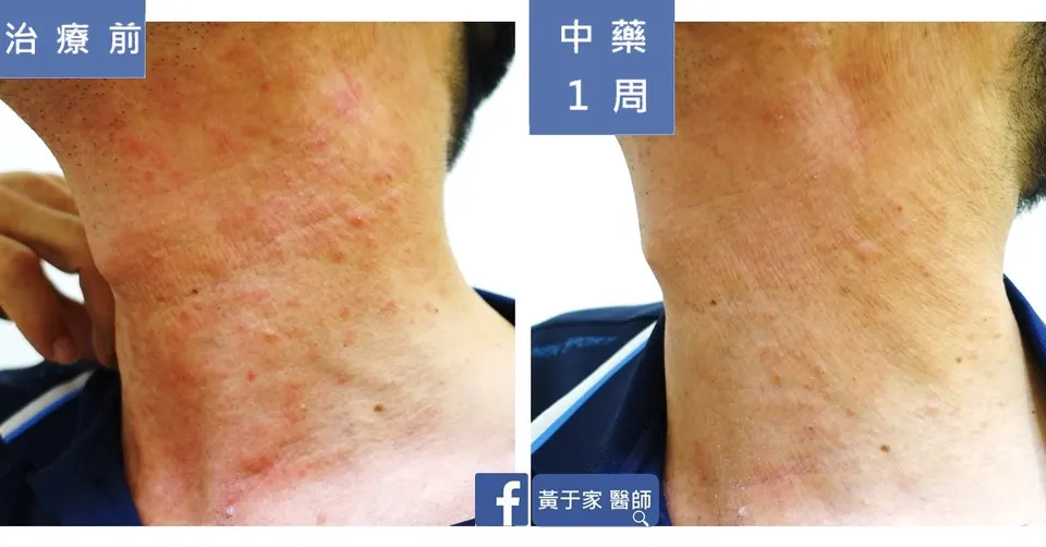 濕疹患者頸部左側治療前後對照（中藥 1 週）