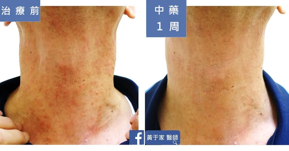 濕疹患者頸部正面治療前後對照（中藥 1 週）