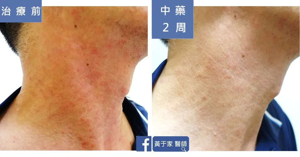 濕疹患者頸部右側治療前後對照（中藥 2 週）