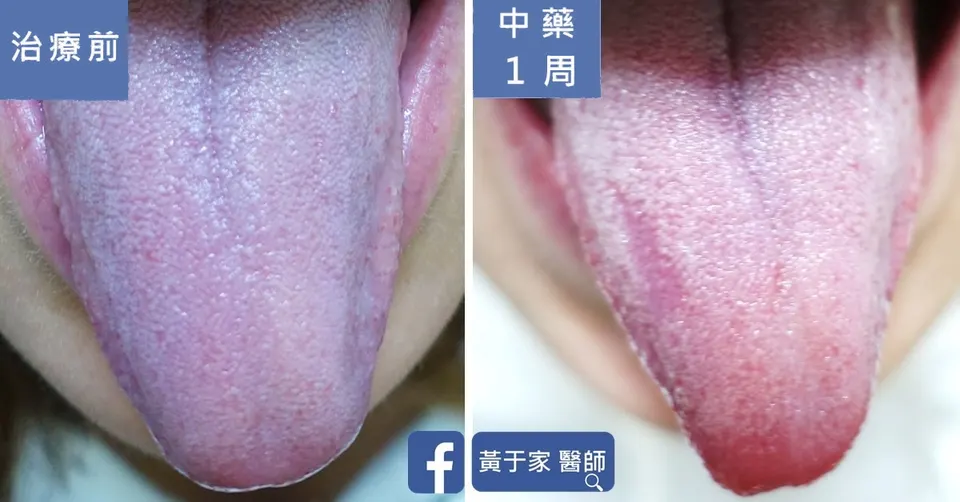 第二位患者的舌頭比對，左標示「治療前」，舌色瘀紫；右標示「中藥 1 周」，舌色轉為淡紅