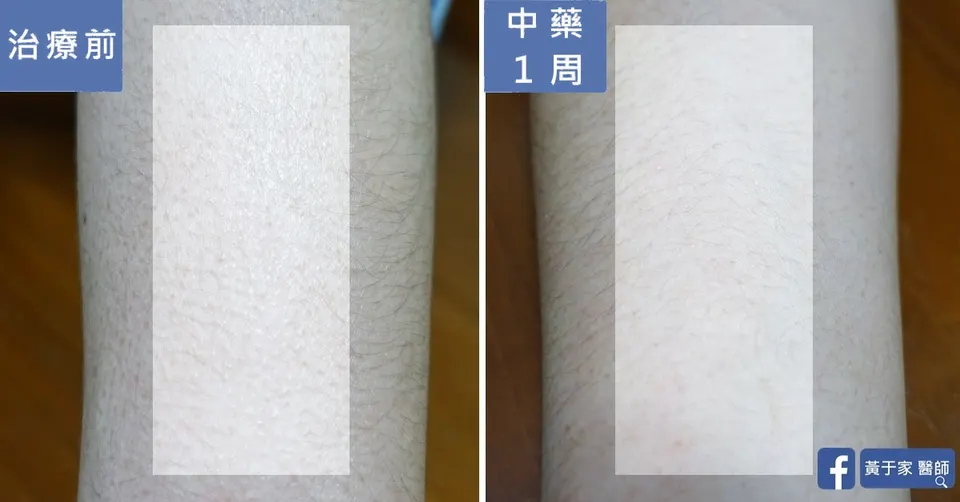 同一位患者手臂皮膚的特寫比對，左標示「治療前」，皮膚有雞皮疙瘩狀突起；右標示「中藥 1 周」，膚質變細