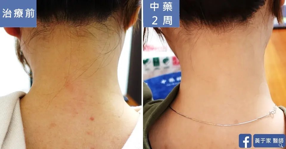 同一位患者後頸的比對，左標示「治療前」，膚色暗沉蠟黃；右標示「中藥 2 周」，膚色變亮