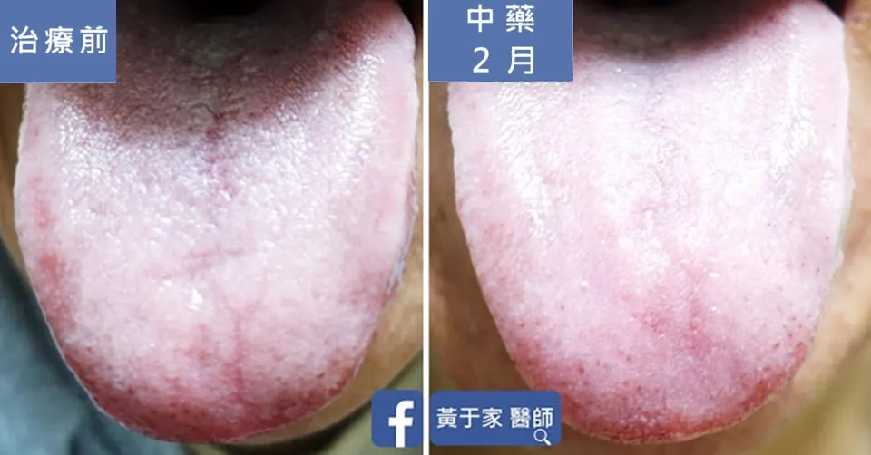 同一位患者的舌頭比對，左標示「治療前」，舌側有瘀斑、舌質偏暗；右標示「中藥 2 月」，舌質轉為嫩紅、瘀斑減輕