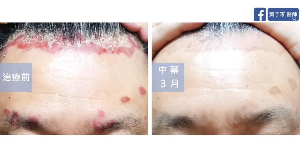 臉部乾癬合併肝炎患者額頭治療前後對照（中藥 3 個月）