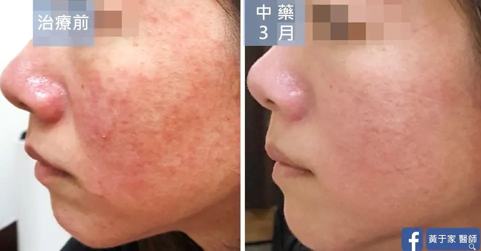 類固醇酒糟側臉泛紅治療前後對照（中藥 3 個月）