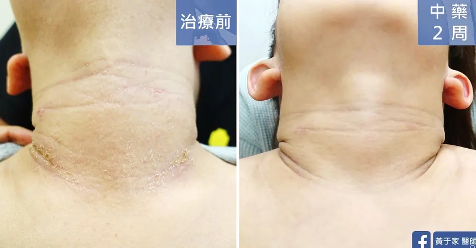 異位性皮膚炎幼童頸部治療前後對照（中藥 2 週）