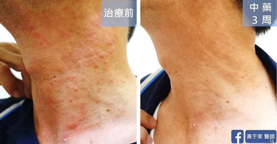 濕疹患者頸部紅疹治療前後對照（中藥 3 週）
