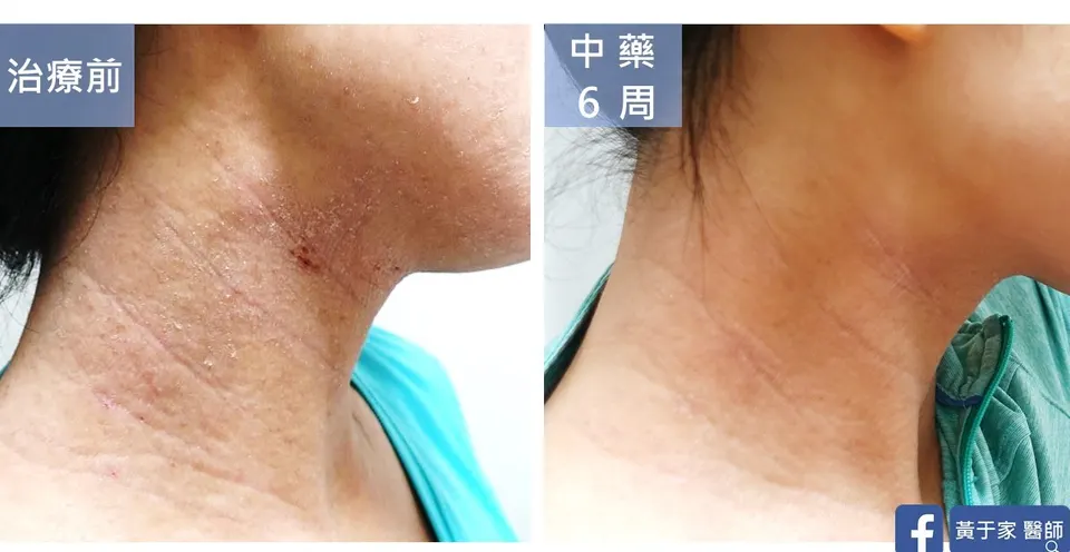 丹羽療法後異位性皮膚炎患者頸部治療前後對照（中藥 6 週）