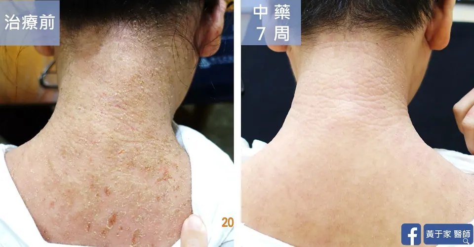 異位性皮膚炎疑似類固醇戒斷後頸治療前後對照（中藥 7 週）