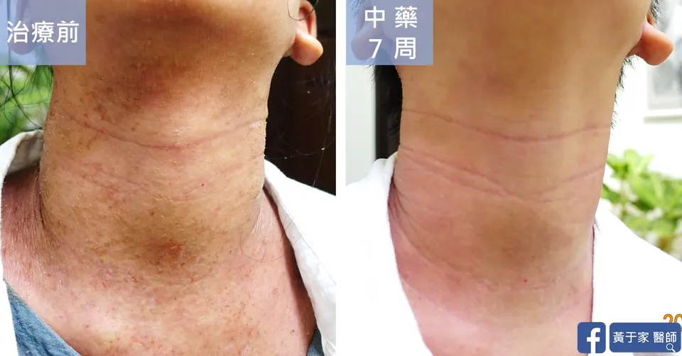 異位性皮膚炎疑似類固醇戒斷頸部正面治療前後對照（中藥 7 週）