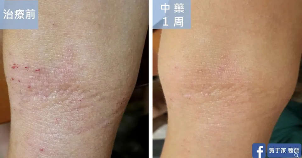關節彎曲處濕疹抓痕治療前後對照（中藥 1 週）