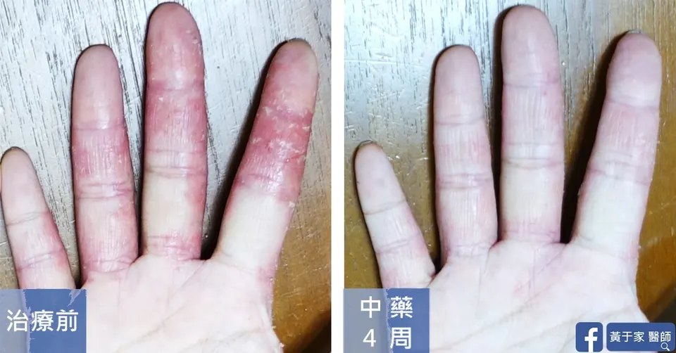 手指紅腫脫皮濕疹治療前後對照（中藥 4 週）