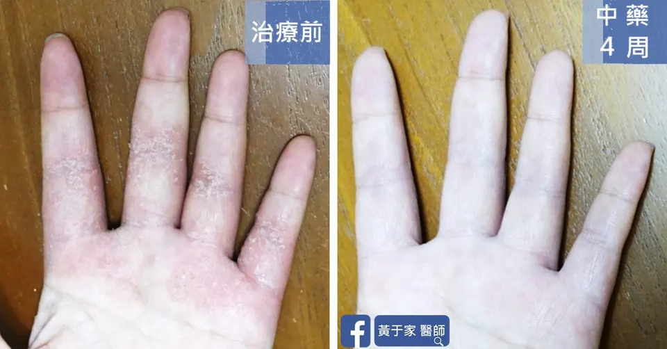 手部濕疹手掌與手指治療前後對照（中藥 4 週）